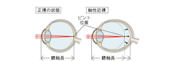 近視の進行を抑制することが大切な理由