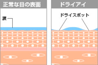 ドライアイ