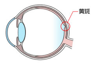 黄斑変性症