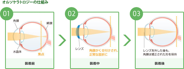 オルソケラトロジーの仕組み